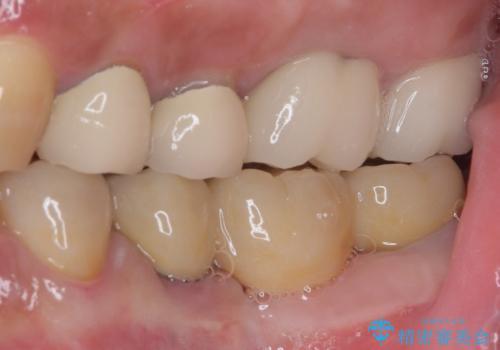 インプラントや歯周外科処置を用いた奥歯の補綴治療の治療後