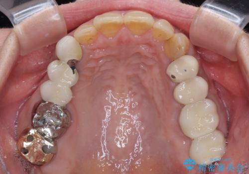 インプラントや歯周外科処置を用いた奥歯の補綴治療の治療後