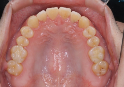 内側に入っていた前歯とガタつきをインビザラインで綺麗に並べるの治療後