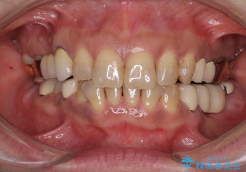 インプラントや歯周外科処置を用いた奥歯の補綴治療の治療前