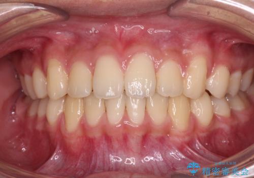 前歯の隙間とデコボコを改善 高校生のインビザライン治療の治療中