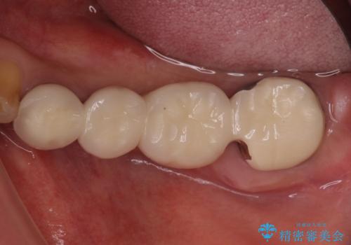 インプラントや歯周外科処置を用いた奥歯の補綴治療の治療前