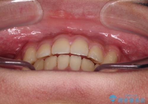 前歯の隙間とデコボコを改善　高校生のインビザライン治療の治療中