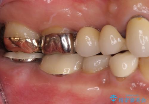 インプラントや歯周外科処置を用いた奥歯の補綴治療の治療前