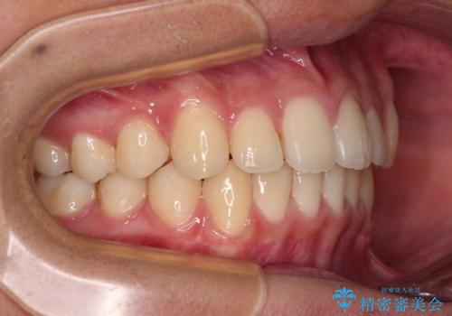 前歯の隙間とデコボコを改善 高校生のインビザライン治療の治療中