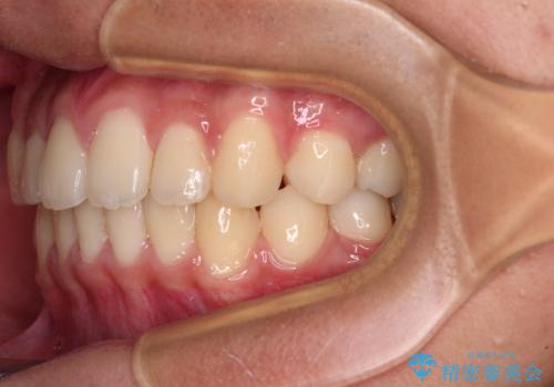 前歯の隙間とデコボコを改善 高校生のインビザライン治療の治療中