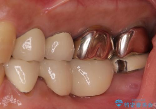 インプラントや歯周外科処置を用いた奥歯の補綴治療の治療前