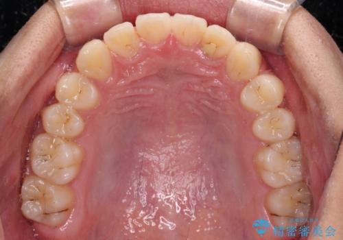 前歯の隙間とデコボコを改善　高校生のインビザライン治療の治療中