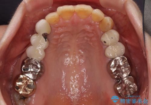 インプラントや歯周外科処置を用いた奥歯の補綴治療の治療前