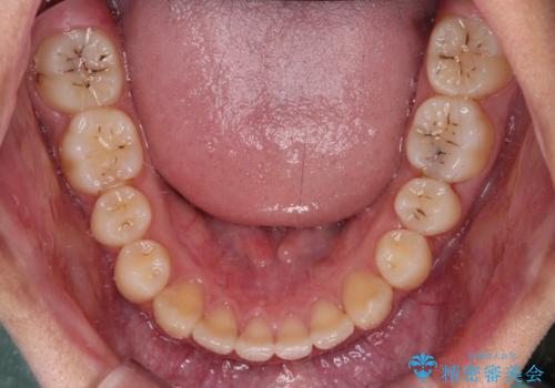 前歯の隙間とデコボコを改善 高校生のインビザライン治療の治療中