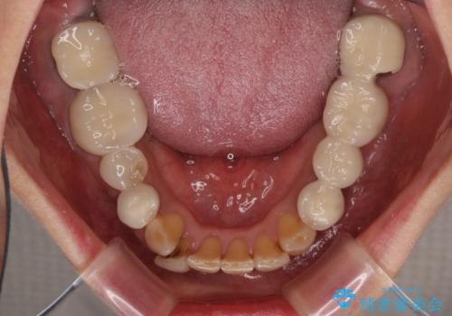 インプラントや歯周外科処置を用いた奥歯の補綴治療の症例 治療前
