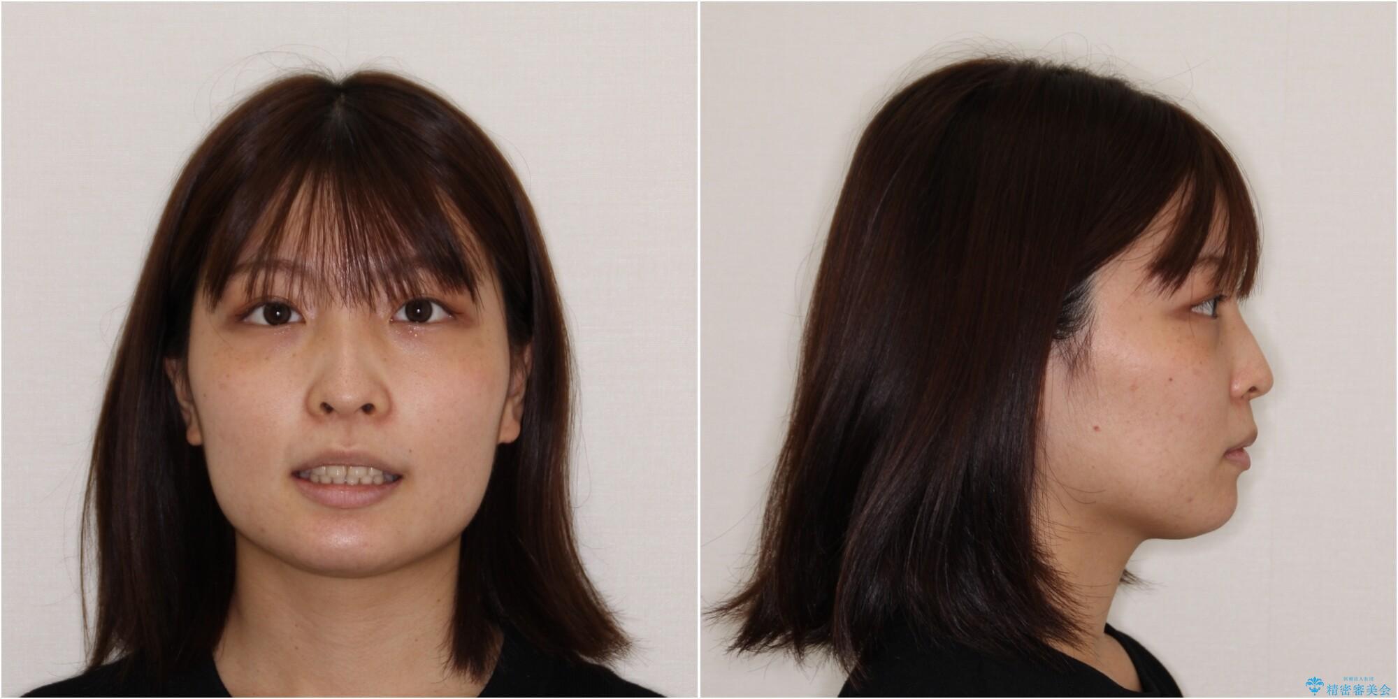 【モニター】治療途中で引っ越し ワイヤー装置を用いた抜歯矯正の治療後(顔貌)