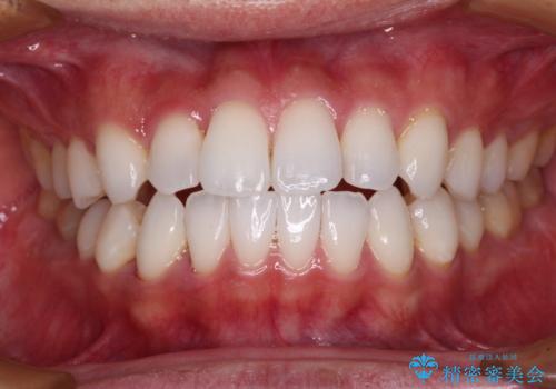 前歯のクロスバイトを改善 インビザラインによる矯正治療の治療中