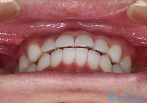 前歯のクロスバイトを改善 インビザラインによる矯正治療の治療中