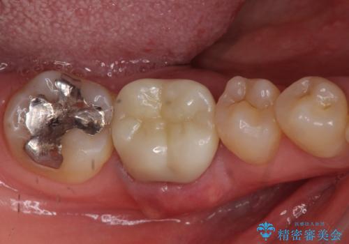 他院で奥歯の初めての根の治療を10回以上通った上に抜歯と言われた　歯茎が腫れて痛いの治療前