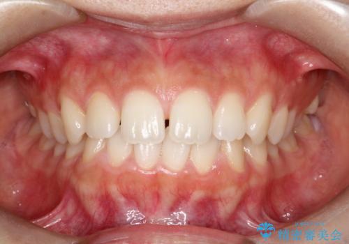 空隙歯列弓(すきっ歯)の症例 治療前