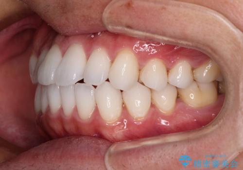 前歯のクロスバイトを改善 インビザラインによる矯正治療の治療中