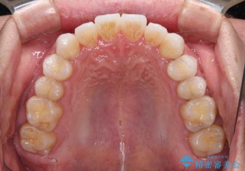 前歯のクロスバイトを改善 インビザラインによる矯正治療の治療中