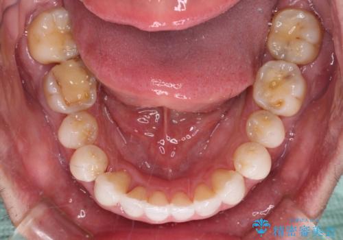 前歯のクロスバイトを改善　インビザラインによる矯正治療の治療中