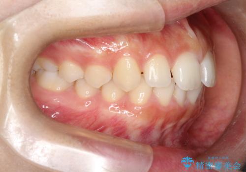 【インビザライン】前歯のすき間をなおしたい。の治療前