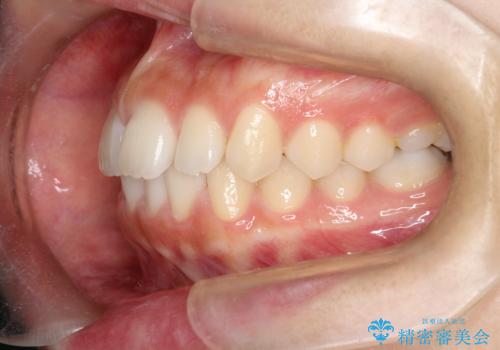 【インビザライン】前歯のすき間をなおしたい。の治療前