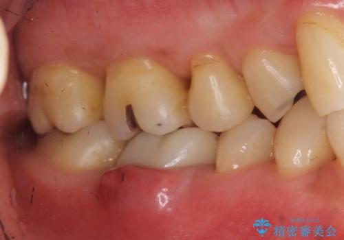 他院で奥歯の初めての根の治療を10回以上通った上に抜歯と言われた　歯茎が腫れて痛いの症例 治療前