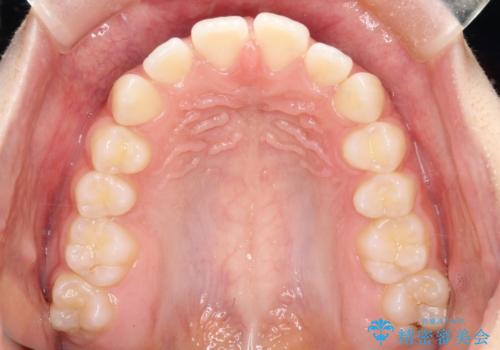 【インビザライン】前歯のすき間をなおしたい。の治療前