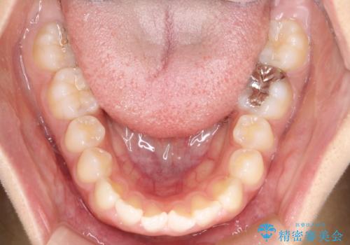 【インビザライン】前歯のすき間をなおしたい。の治療前