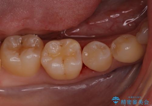 定期検診に来たら虫歯があった。の治療後
