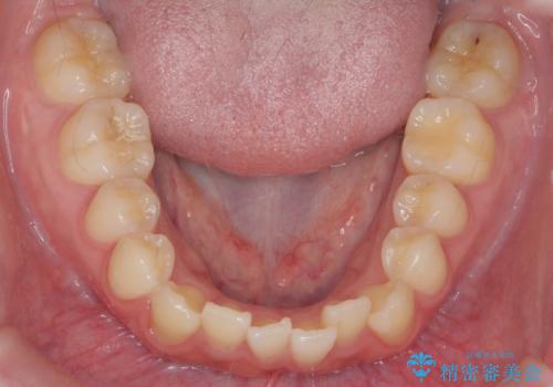 [ マウスピース矯正 ]  とび出ている前歯を治したいの治療前
