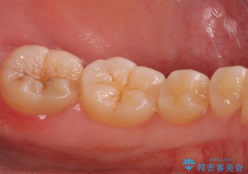 奥歯の虫歯　セラミックインレーでの治療の治療前