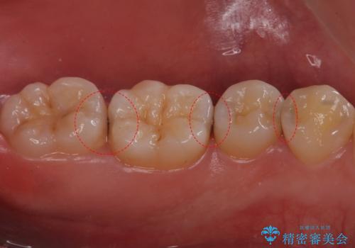 歯と歯の間の虫歯　セラミックインレーでの治療