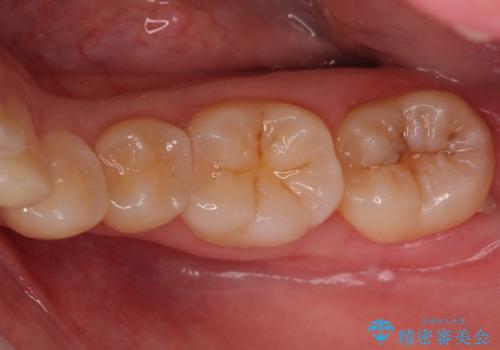 奥歯の虫歯 セラミックインレーでの治療の治療前