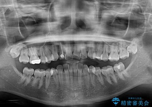 【モニター】前歯のデコボコと変色した前歯をインビザラインとオールセラミッククラウンでの治療前