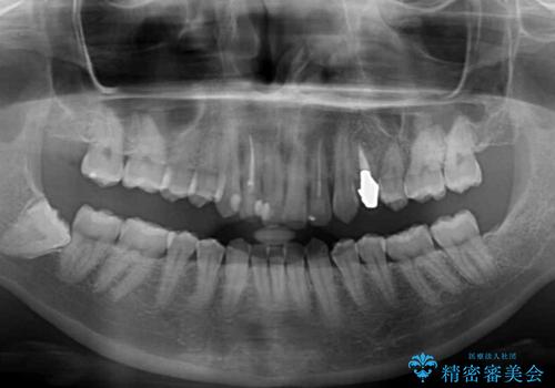 【モニター】前歯の変色とデコボコを改善 インビザラインとオールセラミックの治療前
