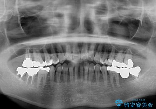 前歯の突出感と上下の隙間 インビザラインによる矯正治療の治療前
