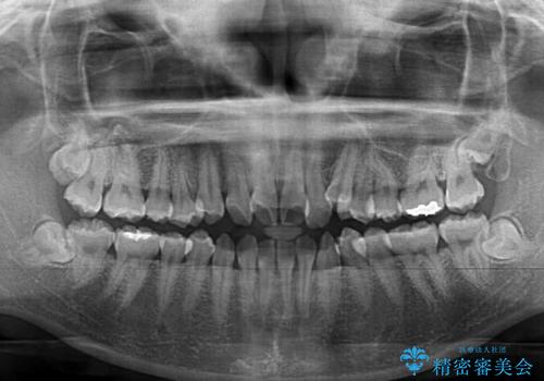 【モニター】前歯のデコボコを改善 ワイヤー矯正を併用したインビザライン矯正の治療前