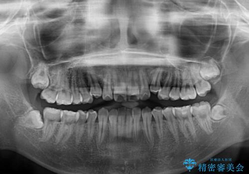 カリエール・ディスタライザーとインビザラインを用いた八重歯の改善の治療前