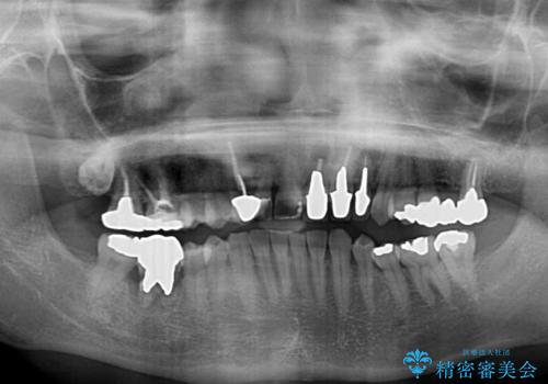 歯が全く咬みあわない 矯正と補綴の全顎治療の治療前