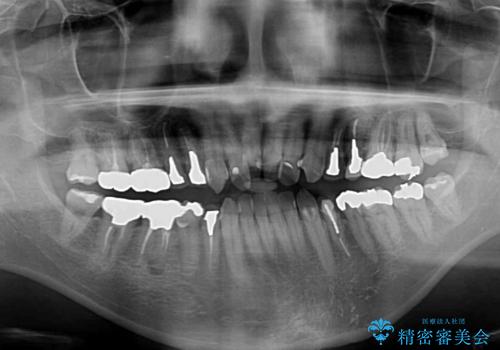 飛び出した前歯と目立つ銀歯 矯正とセラミックの総合歯科診療の治療前