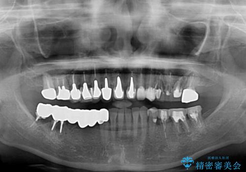 以前治療した歯がボロボロに 全顎補綴治療の治療前