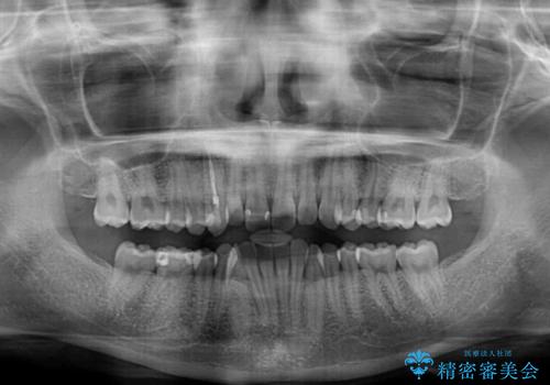 【モニター】下顎の気になる八重歯を改善　インビザラインによる矯正治療の治療前