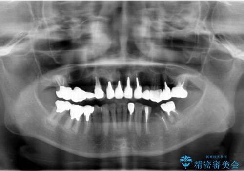 全顎的 虫歯治療 インプラント補綴の治療前