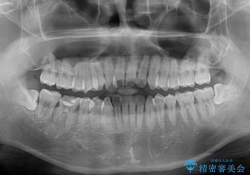 前歯のクロスバイトを改善 インビザラインによる矯正治療の治療前