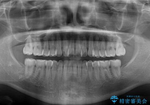 前歯のクロスバイト インビザラインによる矯正治療の治療前