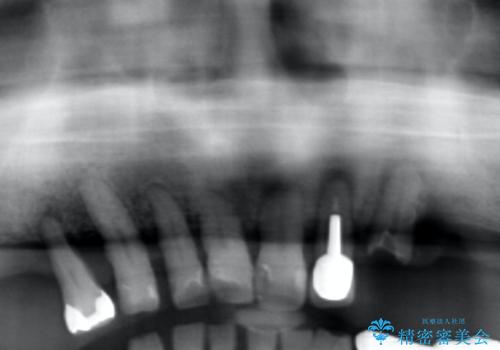 [ 無歯顎の治療 ]   前歯部義歯と臼歯部インプラント補綴の治療前