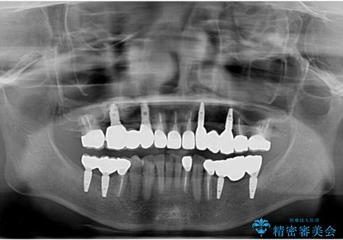 全顎的 虫歯治療 インプラント補綴の治療後