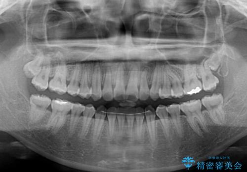 【モニター】前歯のデコボコを改善 ワイヤー矯正を併用したインビザライン矯正の治療後