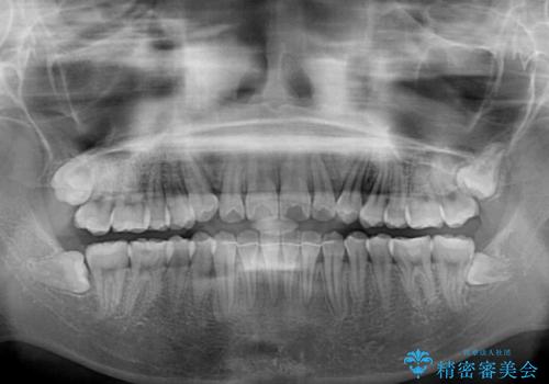 カリエール・ディスタライザーとインビザラインを用いた八重歯の改善の治療後
