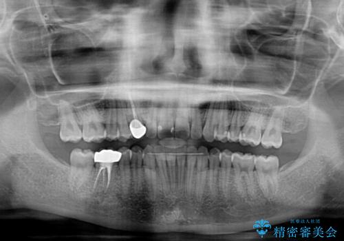 【モニター】下顎の気になる八重歯を改善 インビザラインによる矯正治療の治療後
